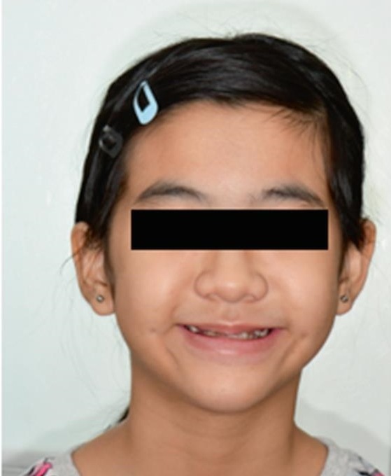 Fotografía extraoral sonriendo