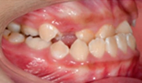 Fotografía intraoral lateral derecha