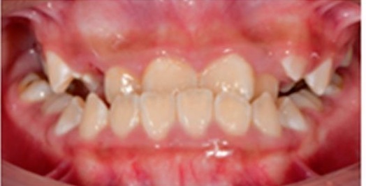 Fotografía intraoral de frente