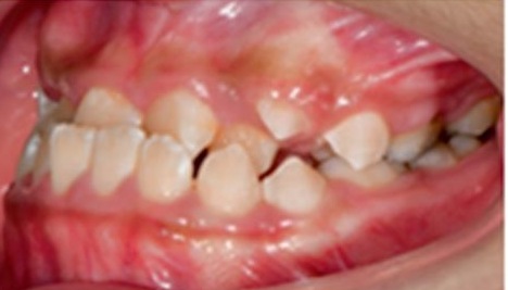 Fotografía intraoral lateral izquierda