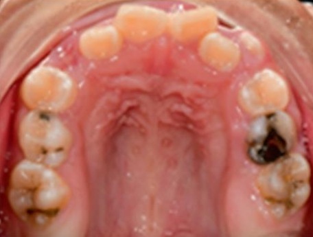 Fotografía oclusal superior