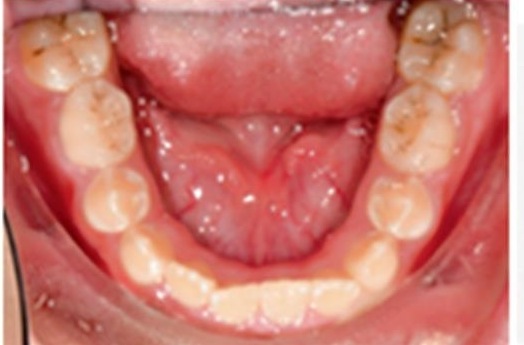 Fotografía oclusal inferior
