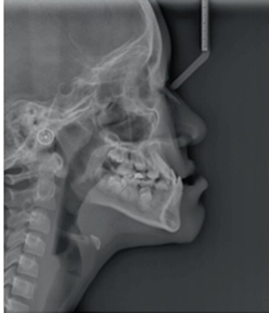 Radiografía lateral de cráneo